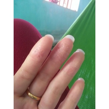 Thảo dược Hết Sạch bong da đầu ngón tay ngón chân, lòng bàn tay, bàn chân