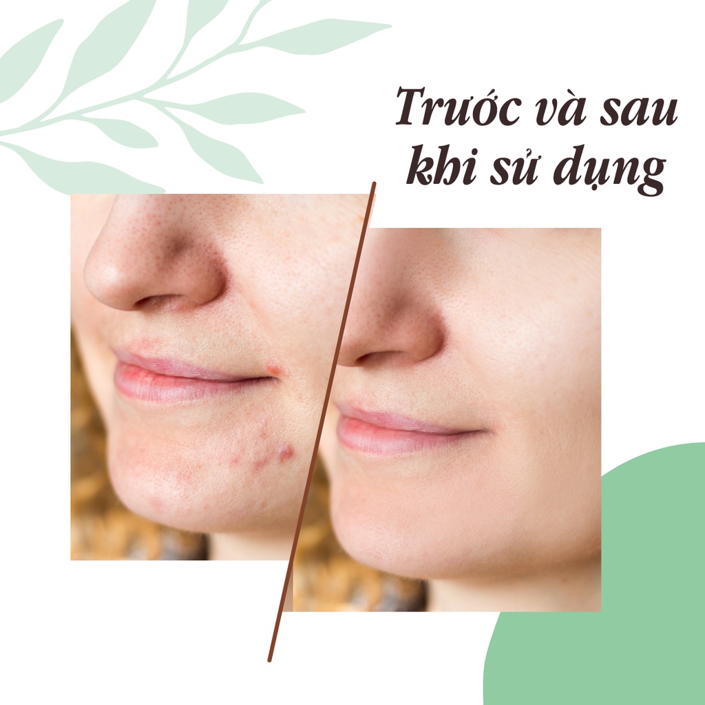 Kem chấm mụn DR. SOMCHAI ACNE SPOT cho mụn trứng cá và mụn viêm, hỗ trợ giảm mụn, giảm sưng đỏ 4g