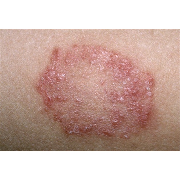 Thảo dược Hết Ngay Nấm ngứa, Nấm hình tròn, Nấm đồng xu, Hắc lào Háng, Bụng, Đùi, Mông