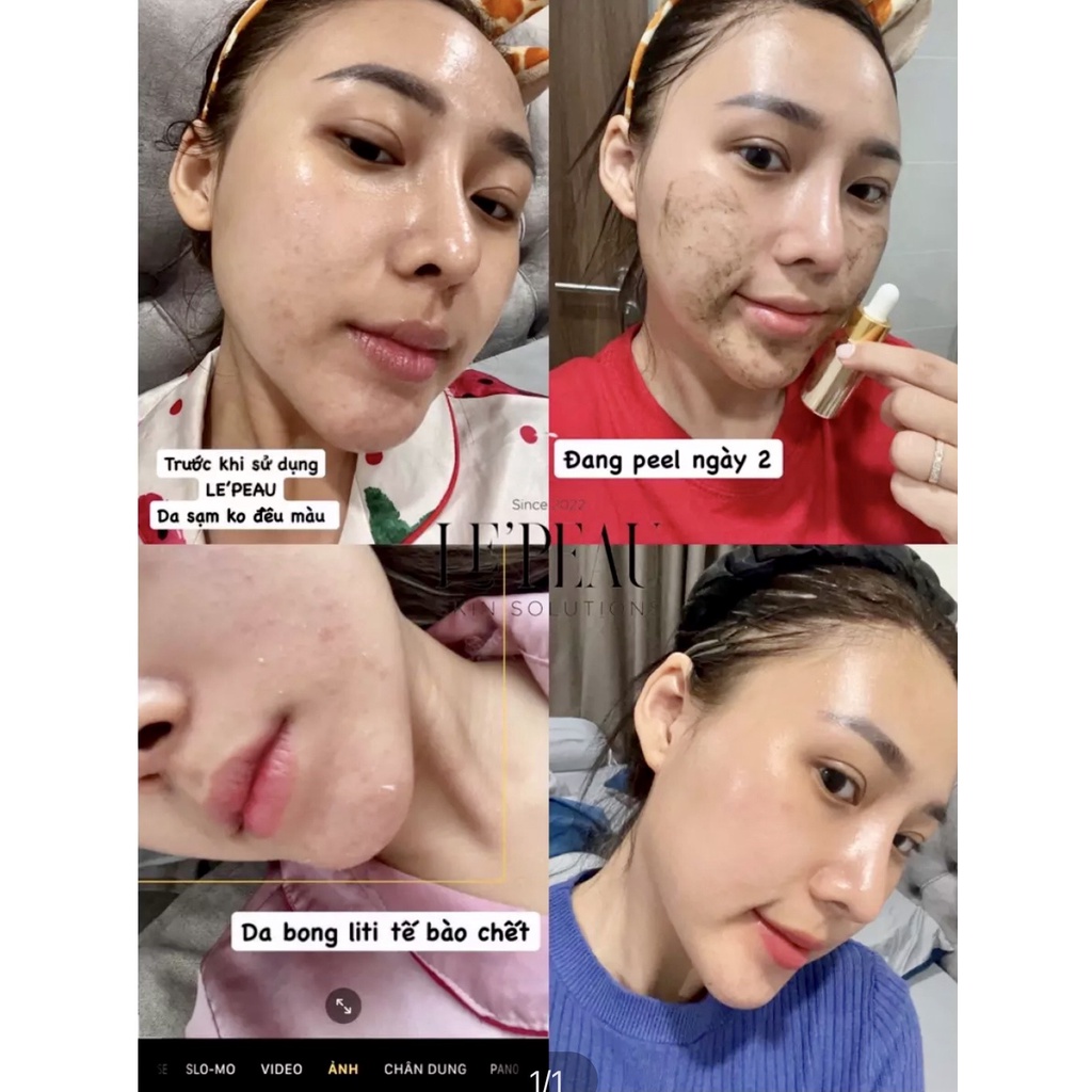 Peel Da Vi Tảo Retinol Le'Peau Mẫu Mới 2022 Thay Da Sinh Học - Tặng Kèm Serum B5 và Serum Chấm Mụn Acne