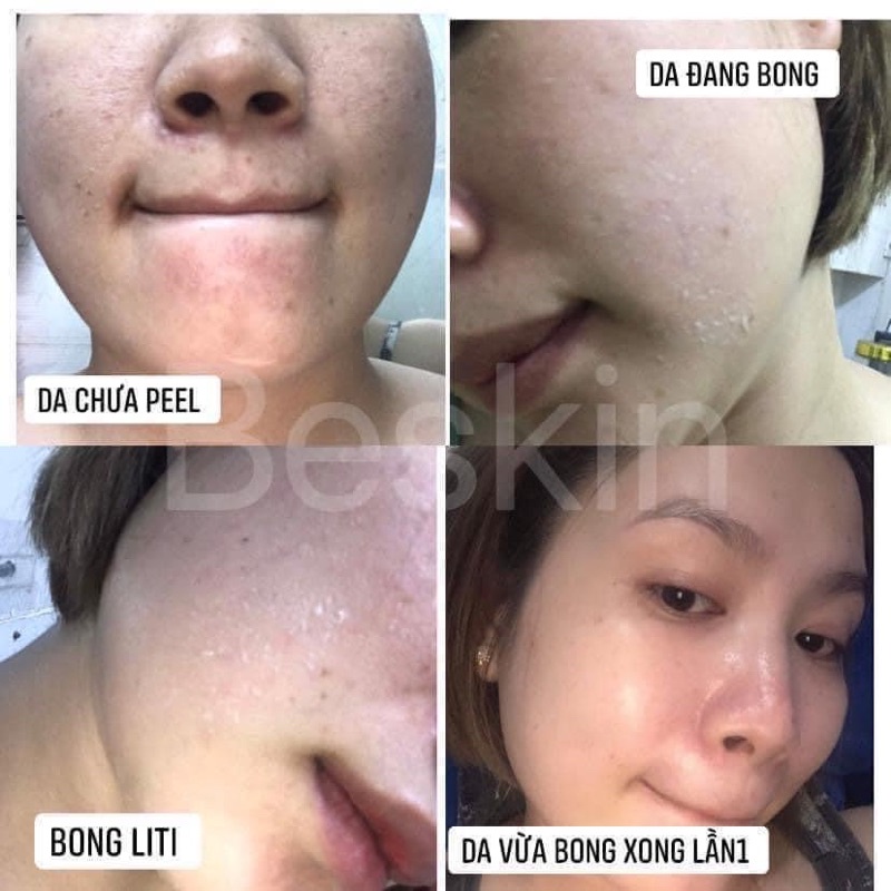 SERUM MỤN BESKIN