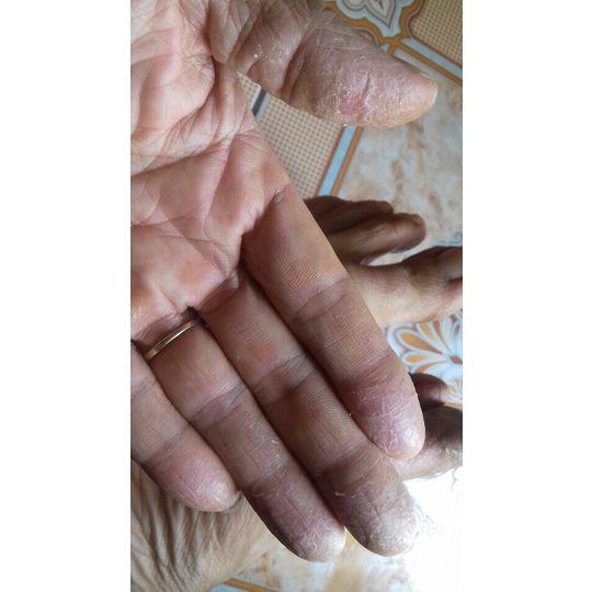 Thảo dược Hết Sạch bong da đầu ngón tay ngón chân, lòng bàn tay, bàn chân