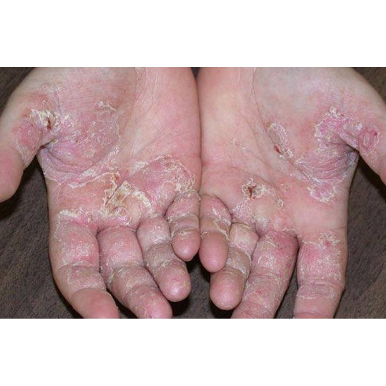 Thảo dược HẾT SẠCH bong da đầu ngón tay ngón chân, lòng bàn tay, bàn chân