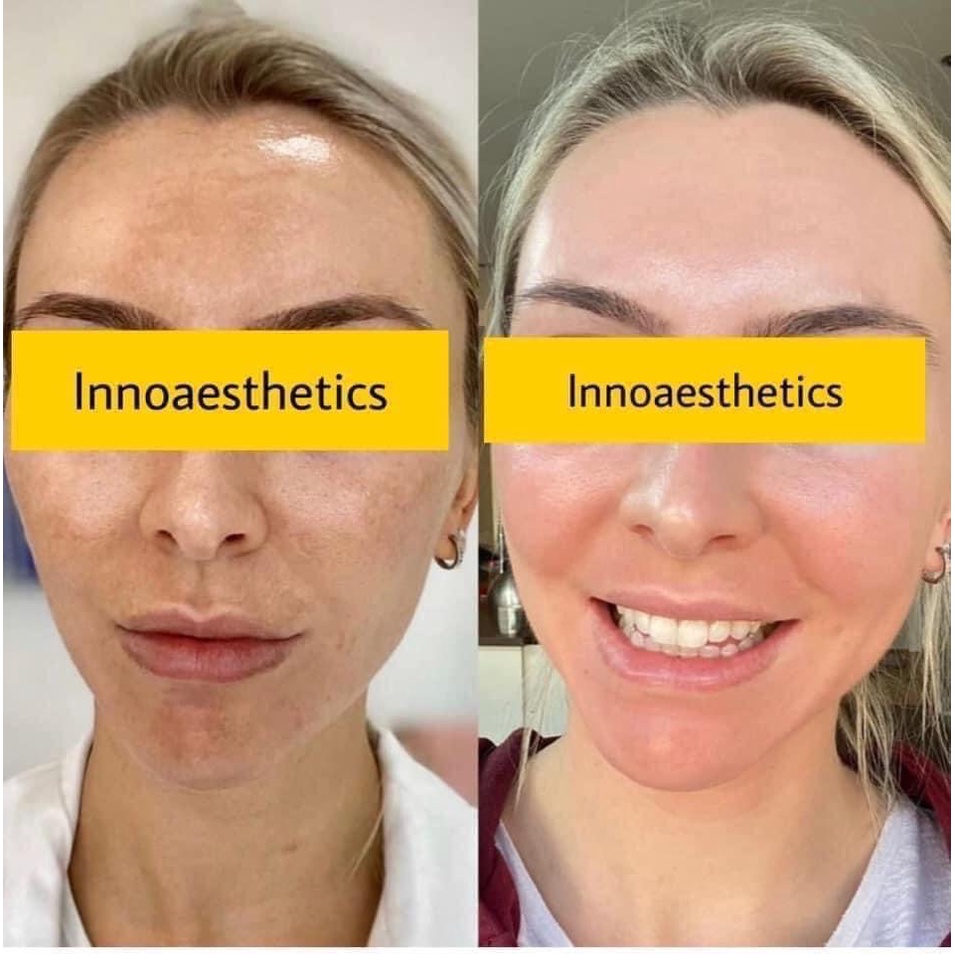 Serum đặc Meline 02 Day Caucasian Skin 30ml - Giảm Nám, Giảm Sắc Tố, Trắng Da