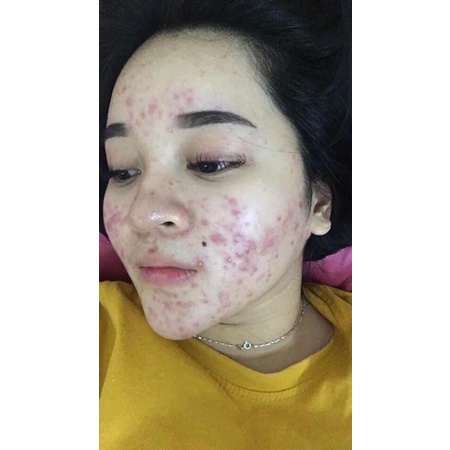 Serum huyet thanh giảm mụn mộc dưỡng da tuyết