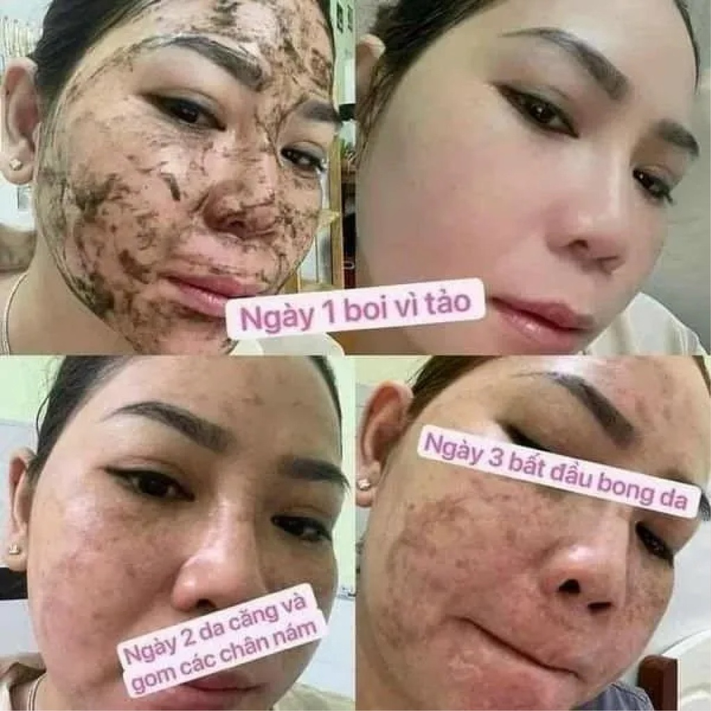 Peel Da Vi Tảo Thảo Dược - Cho Da Mụn, Nám, Lỗ Chân Lông To - Thay Da Sinh Học