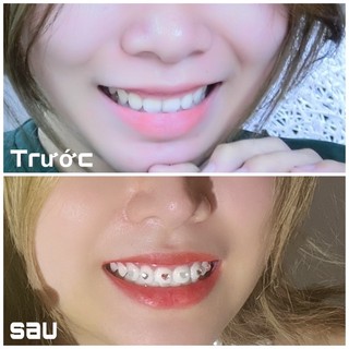 MIMI TEETH WHITENING PEN - 𝑩𝒖́𝒕 𝒕𝒂̂̉𝒚 𝒕𝒓𝒂̆́𝒏𝒈 𝒓𝒂̆𝒏𝒈