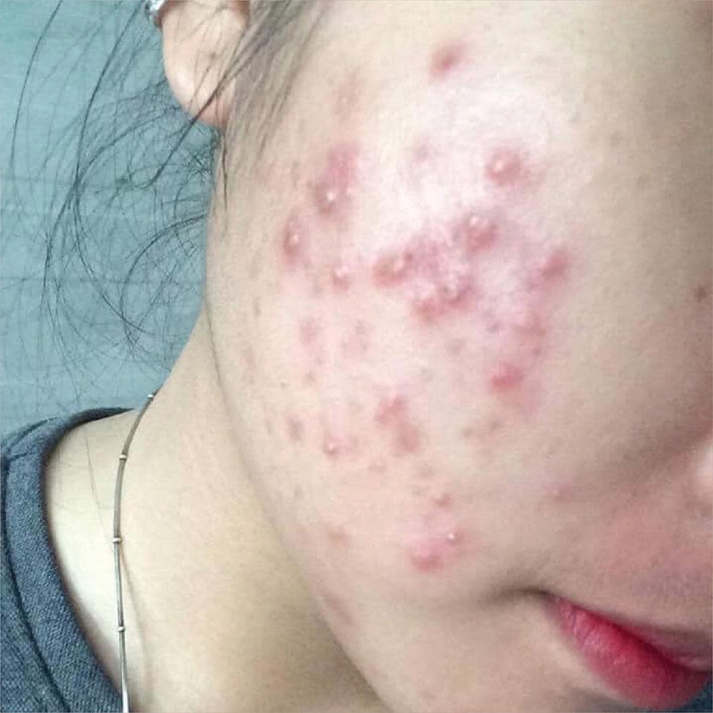 Cao Lá Nam - Serum Huyết Thanh Giảm Mụn Mờ Thâm Dưỡng Da Hiệu Quả - Huyết thanh mộc tuyết - huyết sâm