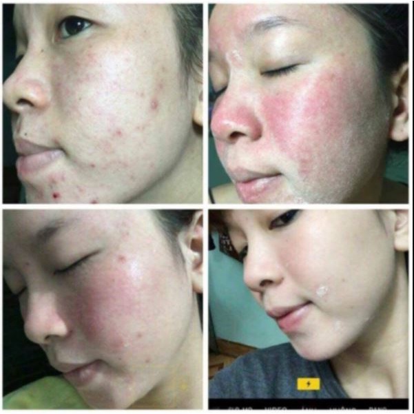 SERUM TÁI TẠO DA NHÂN SÂM Loại Mạnh Chính Hãng SẮC DƯỢC THIÊN 30ml - cải thiện nám tàn nhang xóa mụn tri kỷ da đẹp