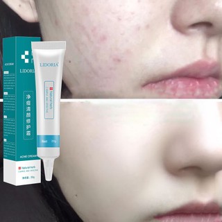 Mới kem mụn kem giảm mụn kem dưỡng giảm mụn 20g gel ngừa mụn làm mờ vết mụn cải thiện xỉn màu kháng khuẩn chốn