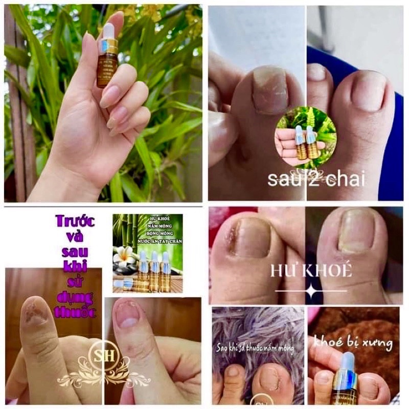 Serum nấm móng ,bọng, hư khóe móng SH