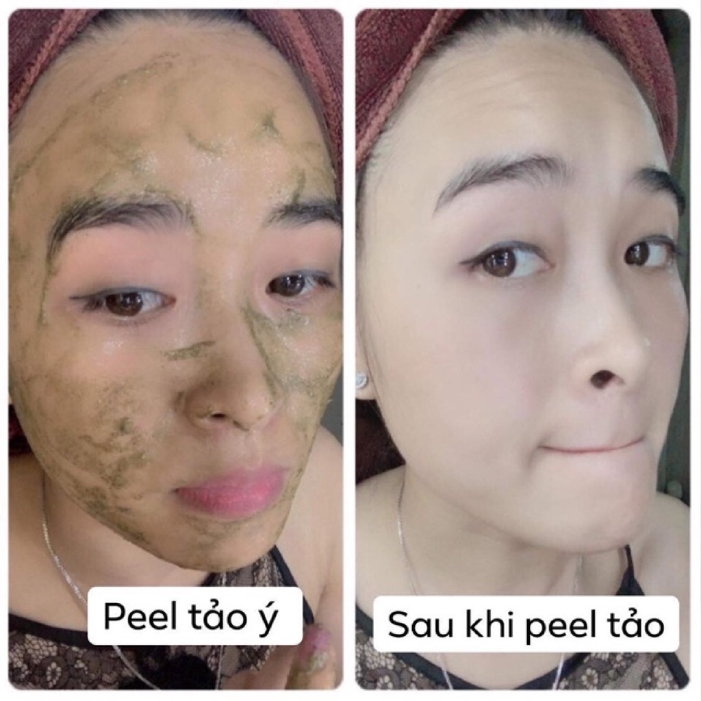Peel Da Vi Tảo Thảo Dược - Cho Da Mụn, Nám, Lỗ Chân Lông To - Thay Da Sinh Học