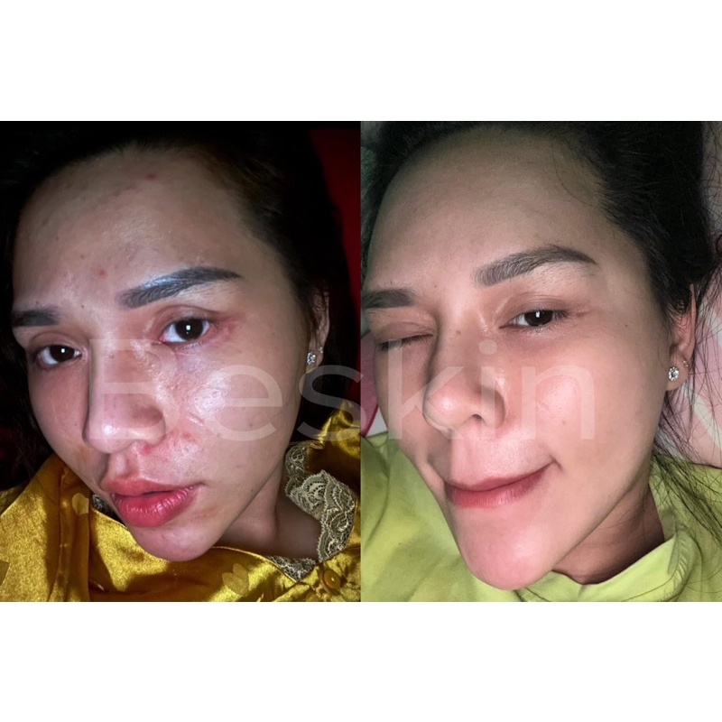 SERUM MỤN BESKIN
