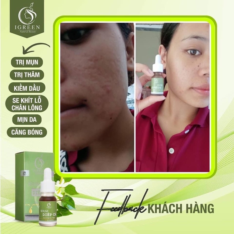 SERUM DIẾP CÁ GIẢM MỤN, THÂM, SE KHÍT LỖ CHÂN LÔNG - IGREEN