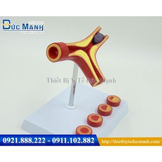 Mô hình xơ vữa mạch