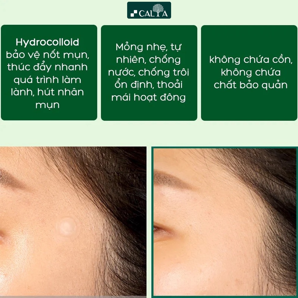 Miếng Dán Xẹp Mụn Some By Mi Che Mụn, Đẩy Nhân Mụn, Giảm Sưng - Some By Mi Clear Spot Patch (18 Miếng Dán)