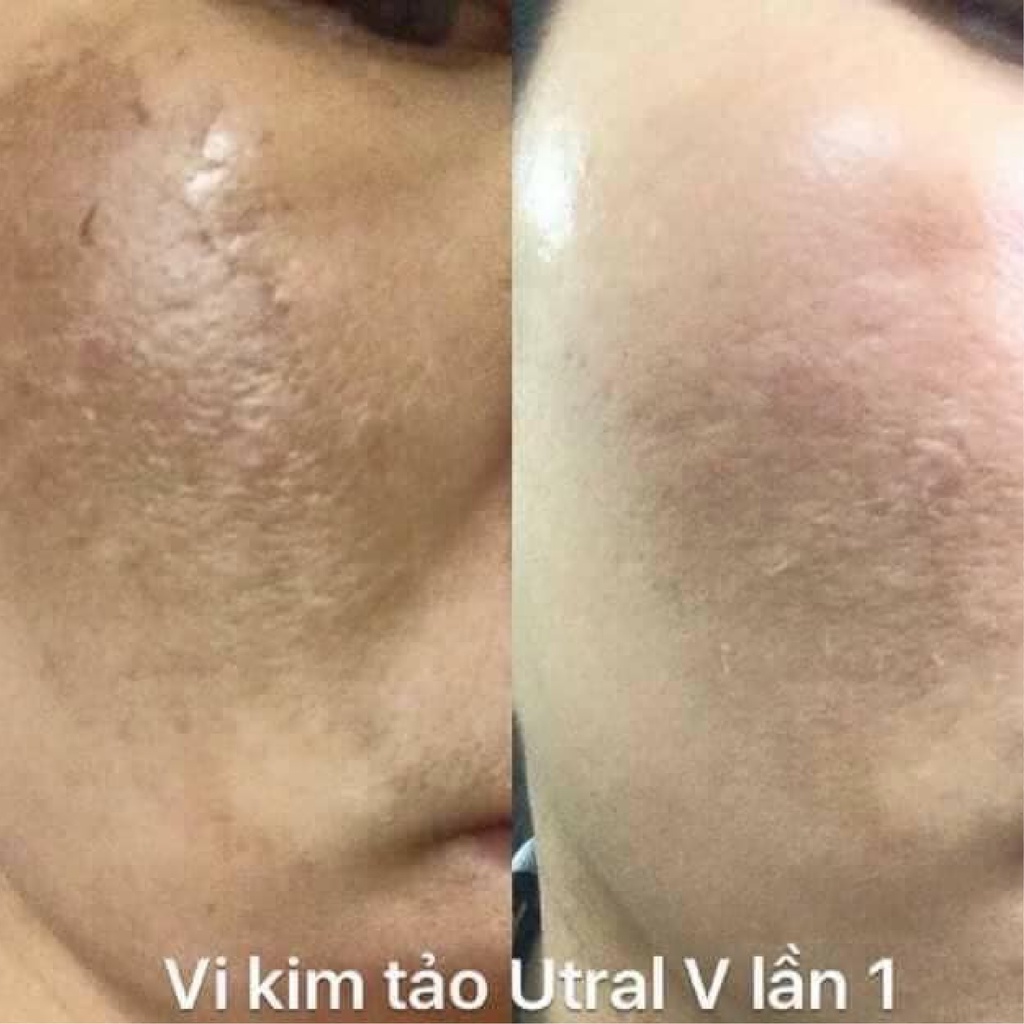 Peel Da Vi Tảo Thảo Dược - Cho Da Mụn, Nám, Lỗ Chân Lông To - Thay Da Sinh Học