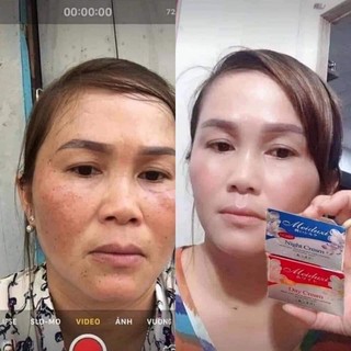 Kem mụn Meiduzi nhật bản