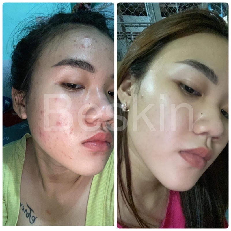 SERUM MỤN BESKIN