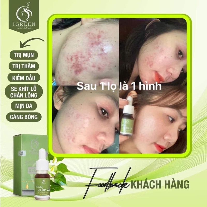 SERUM DIẾP CÁ GIẢM MỤN, THÂM, SE KHÍT LỖ CHÂN LÔNG - IGREEN