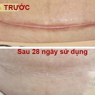Miếng dán ép sẹo lồi ECLAR PLASTER HISAMITSU Nhật Bản