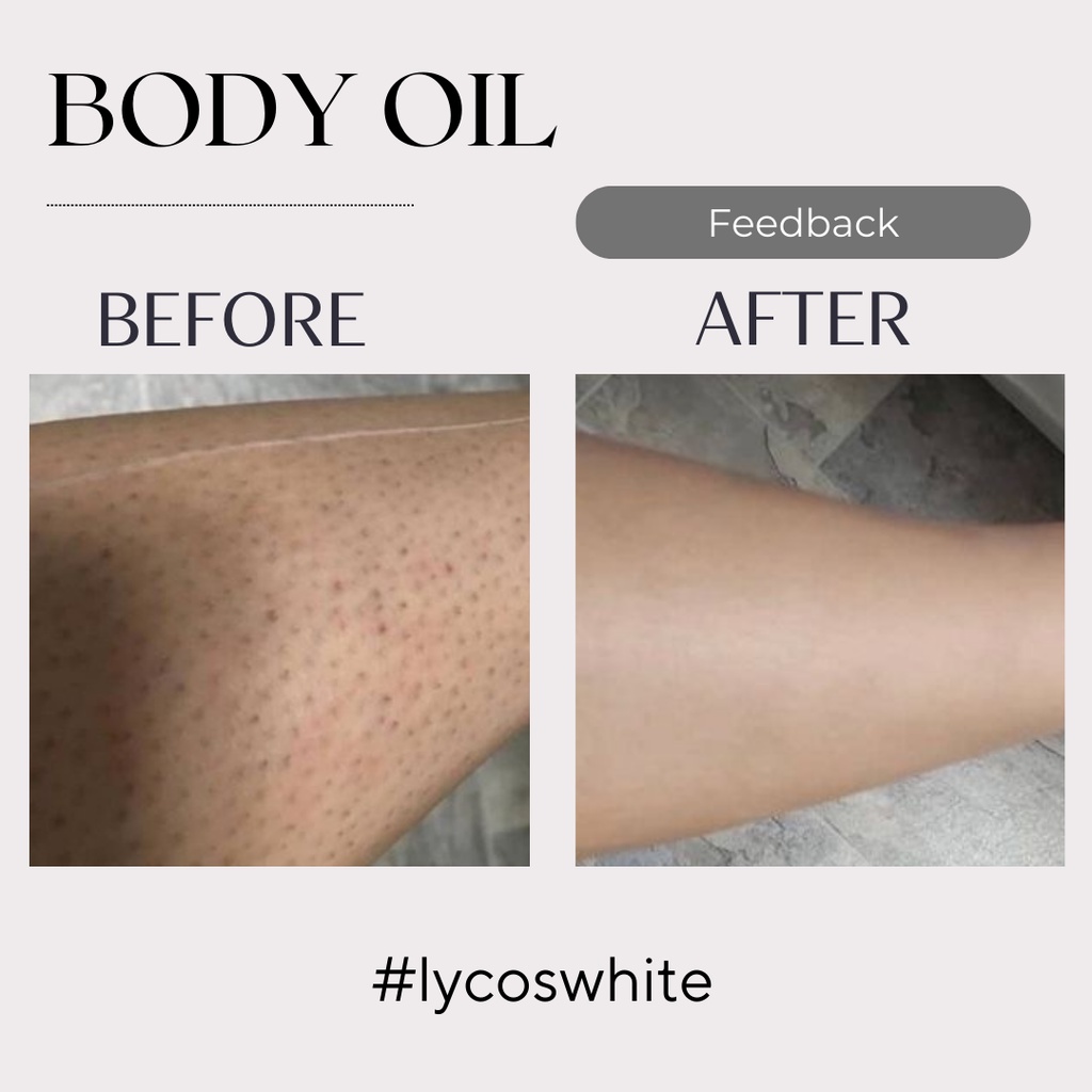 Dầu Dưỡng Da Body Oil 4% BHA Lycos White