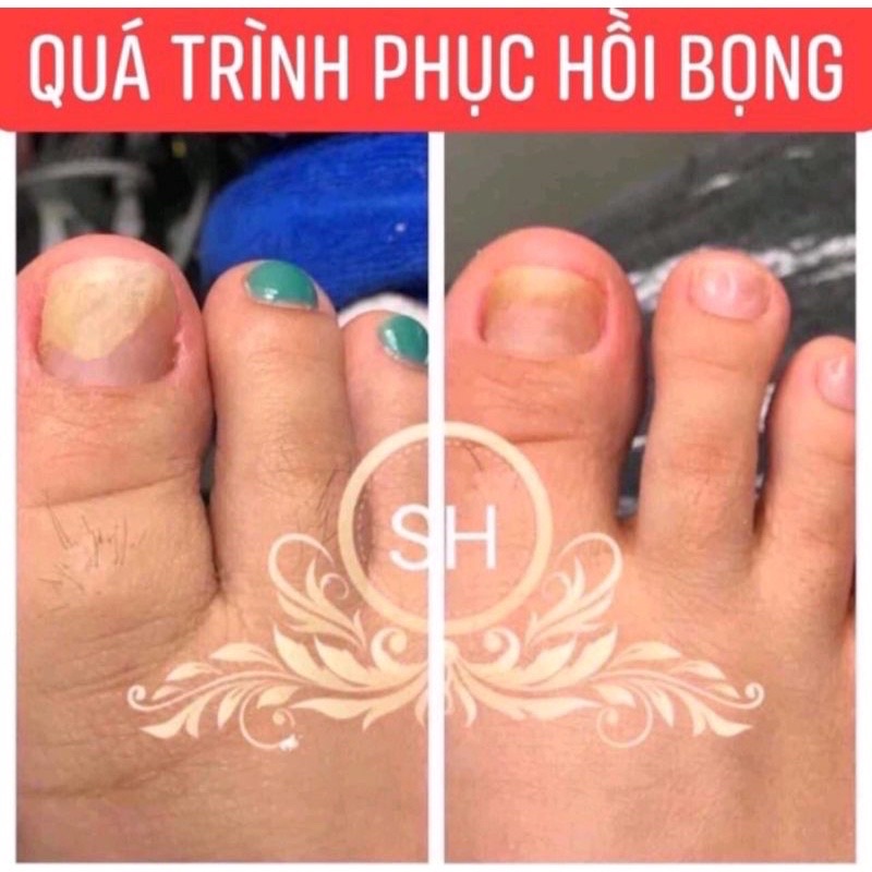 Serum Nấm Móng Tay Chân Khử Nấm Móng Hư Khóe Bọng Móng Nặng Nước Ăn Tay Chân gia Truyền