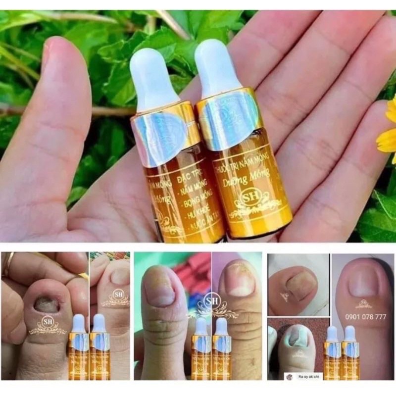 Serum đánh bay nấm móng, hư khoé, bọng móng, nước ăn tay chân gia truyền