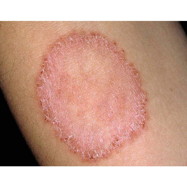 Thảo dược Hết Ngay Nấm ngứa, Nấm hình tròn, Nấm đồng xu, Hắc lào Háng, Bụng, Đùi, Mông