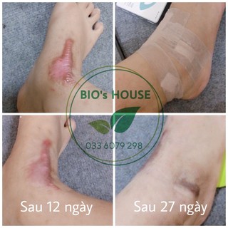 Miếng dán ép sẹo lồi ECLAR PLASTER HISAMITSU Nhật Bản