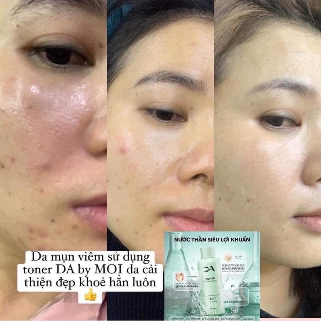 COMBO NƯỚC THẦN  200ML+ 1 SỮA RỬA MẶT 200ML DA BY M.O.I . BÁC SĨ DA LIỄU KHUYÊN DÙNG CHO DA NHẠY CẢM NHẤT LÀNH TÍNH