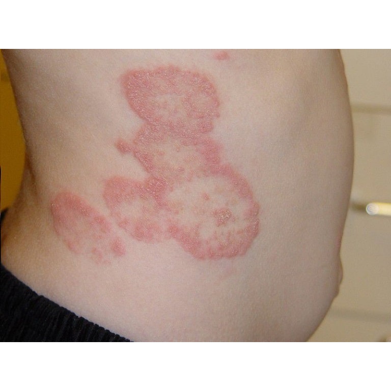 Thảo dược Hết Ngay Nấm ngứa, Nấm hình tròn, Nấm đồng xu, Hắc lào Háng, Bụng, Đùi, Mông