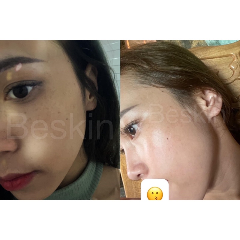 SERUM MỤN BESKIN