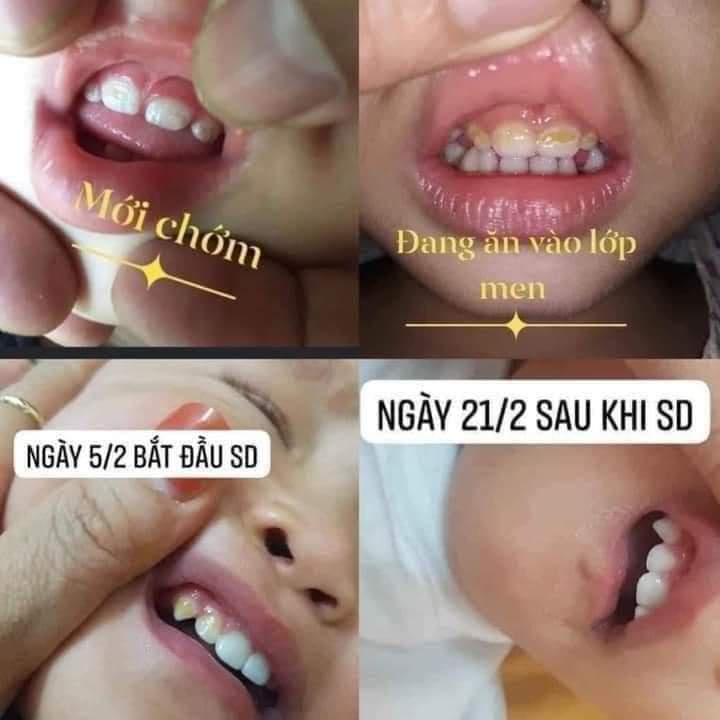 Kem ngừa sâu răng Vecni Flour  ngừa sún răng cho trẻ em và người lớn
