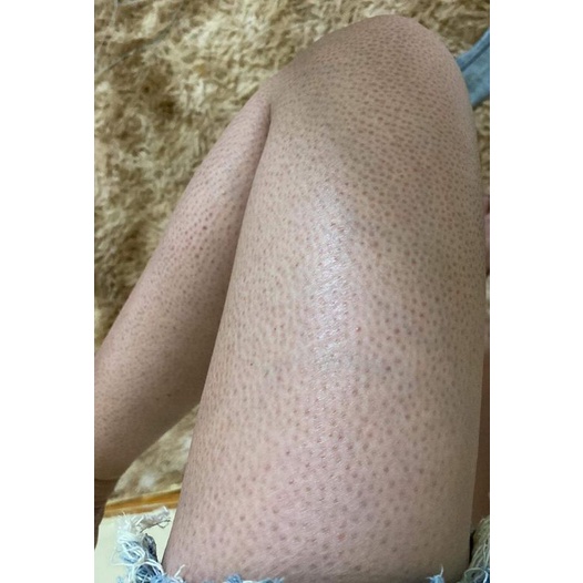 Thảo dược đánh bay Da sần sùi, thô ráp, Viêm nang lông, Viêm lỗ chân lông, Lông quặp