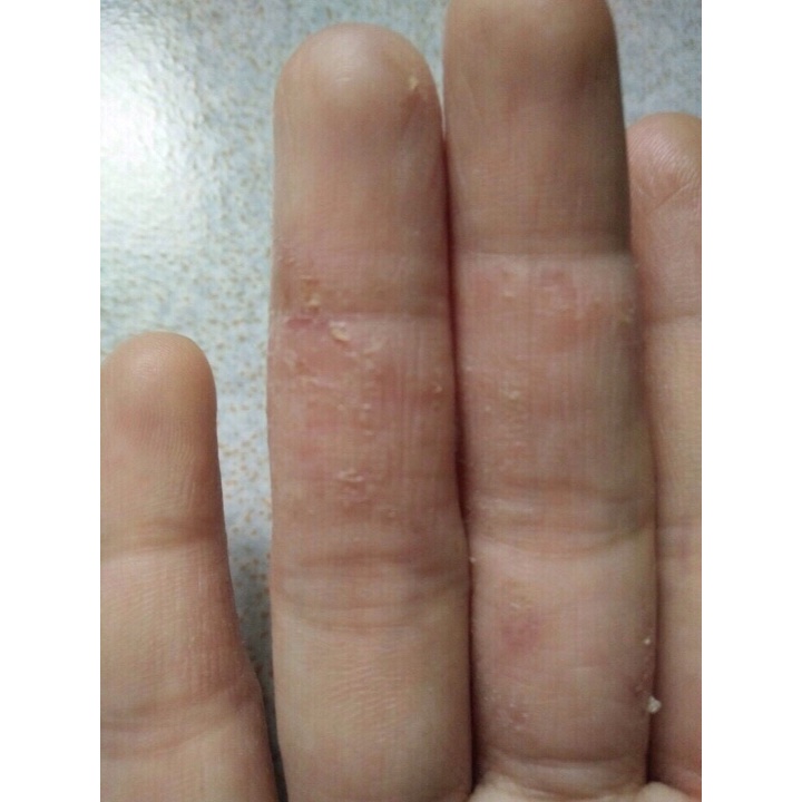 Thảo dược Hết Sạch bong da đầu ngón tay ngón chân, lòng bàn tay, bàn chân