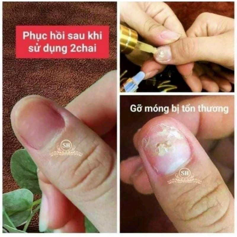 Serum Nấm Móng Tay Chân Khử Nấm Móng Hư Khóe Bọng Móng Nặng Nước Ăn Tay Chân gia Truyền