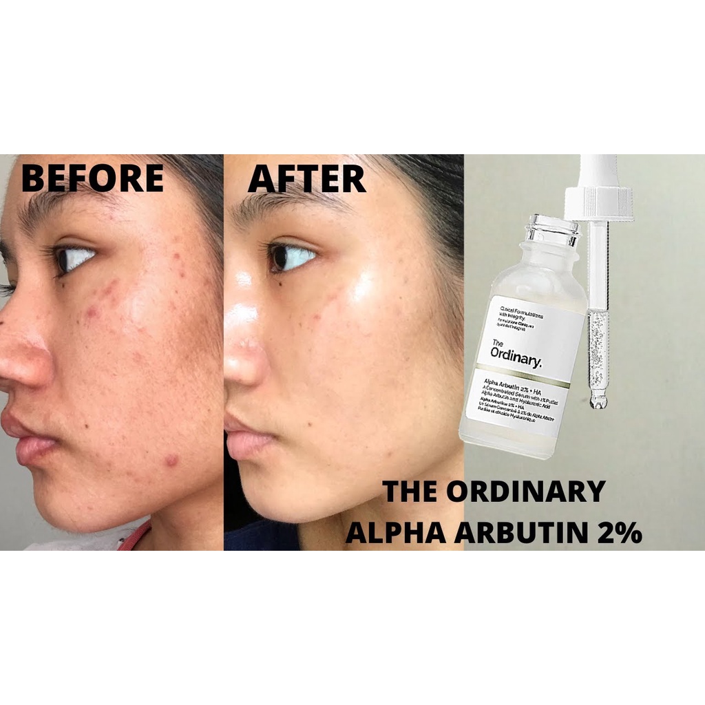 Serum dưỡng trắng mờ thâm nám The Ordinary Alpha Arbutin 2% + Ha 30ml