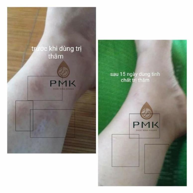 Tinh chất mờ thâm Minh Khang, xóa mờ thâm sẹo,thâm mắt, thâm môi,thâm nách,thâm mụn - an toàn cho bé 6tháng- 30ml | BigBuy360 - bigbuy360.vn