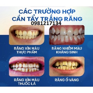 thuốc tẩy trắng răng chuyên dụng cho nha khoa -spa