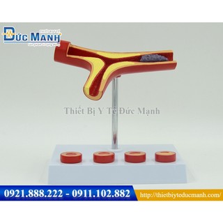 Mô hình xơ vữa mạch