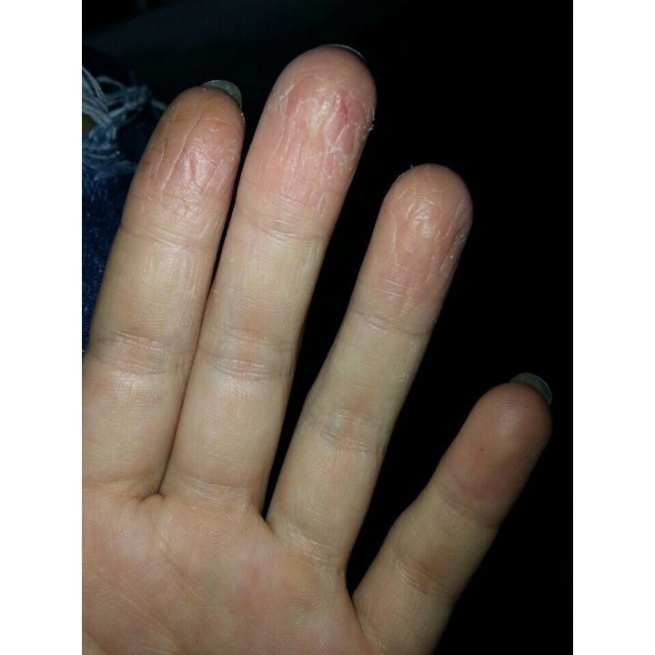 Thảo dược Hết Sạch bong da đầu ngón tay ngón chân, lòng bàn tay, bàn chân