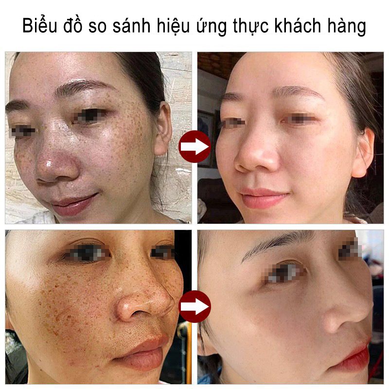 👍🏻👍🏻Kem nám tàn nhang và loại bỏ đốm Loại bỏ các đốm đen sâu làm sáng trắng da chống lão hóa nhanh chóng