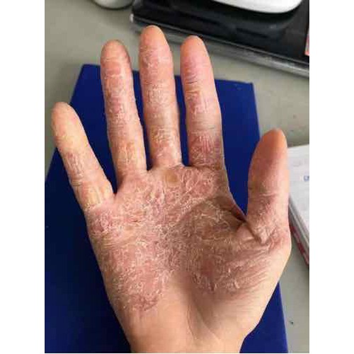 Thảo dược HẾT SẠCH bong da đầu ngón tay ngón chân, lòng bàn tay, bàn chân