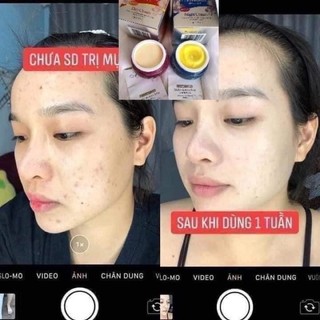 Kem mụn Meiduzi nhật bản