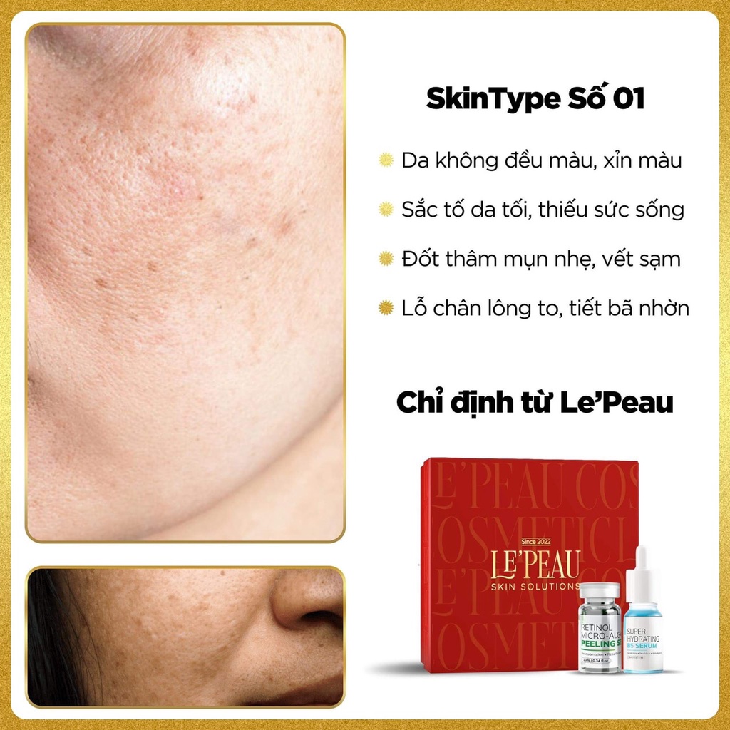 Peel da vi tảo Lepeau sạch mụn thâm sẹo rỗ, hàng công ty phân phối chính hãng