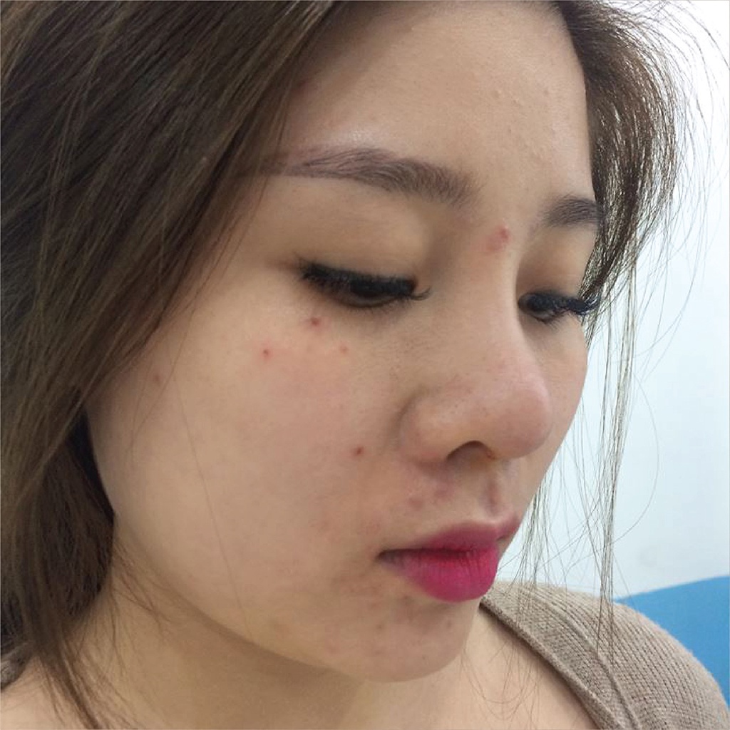 Cao Lá Nam - Serum Huyết Thanh Giảm Mụn Mờ Thâm Dưỡng Da Hiệu Quả - Huyết thanh mộc tuyết - huyết sâm