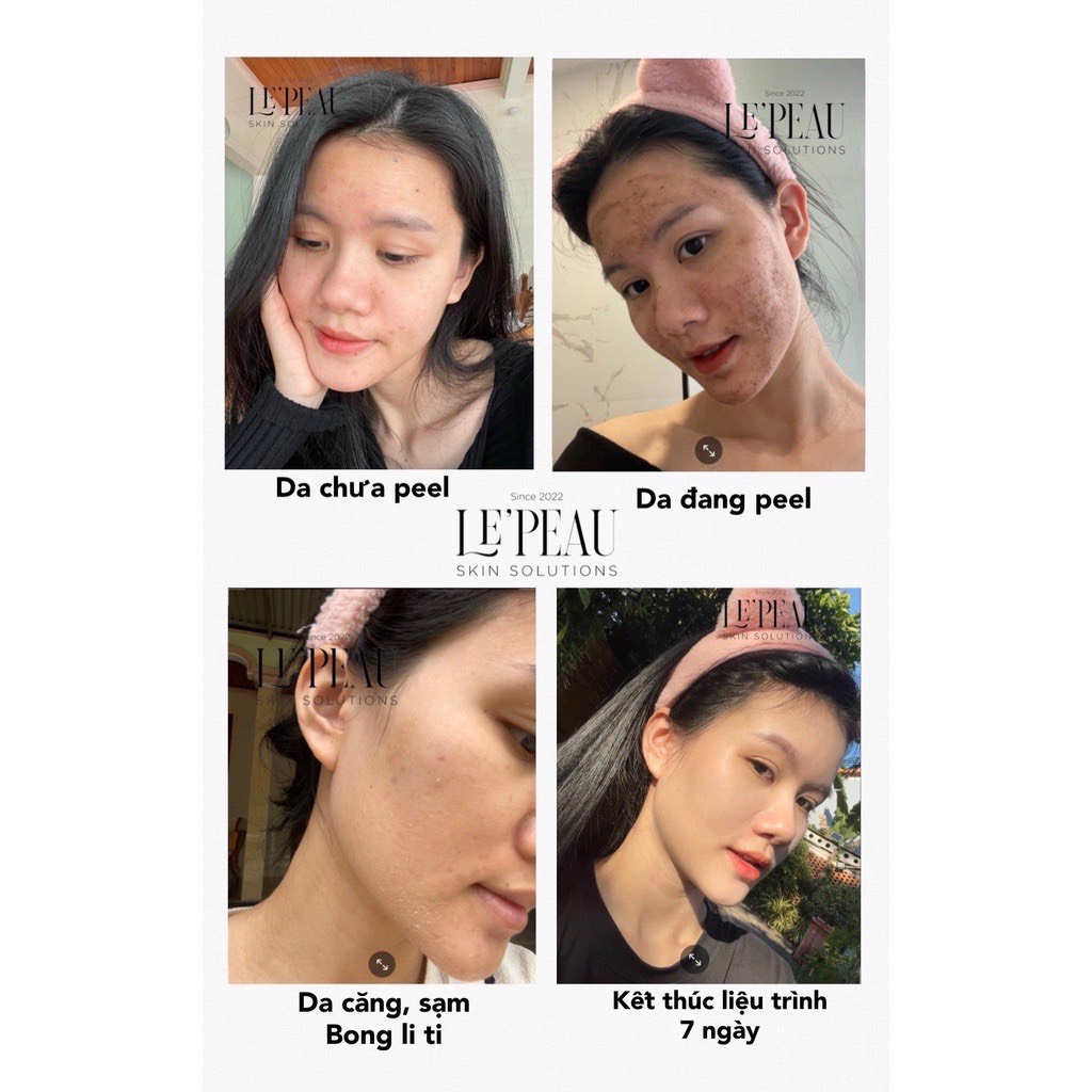 Peel Da Vi Tảo Retinol Le'Peau Mẫu Mới 2022 Thay Da Sinh Học - Tặng Kèm Serum B5 và Serum Chấm Mụn Acne