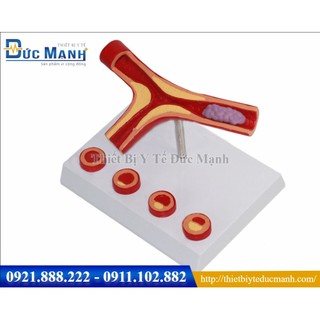 Mô hình xơ vữa mạch