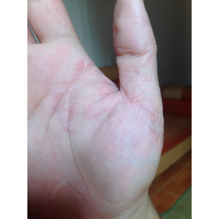 Thảo dược HẾT SẠCH bong da đầu ngón tay ngón chân, lòng bàn tay, bàn chân